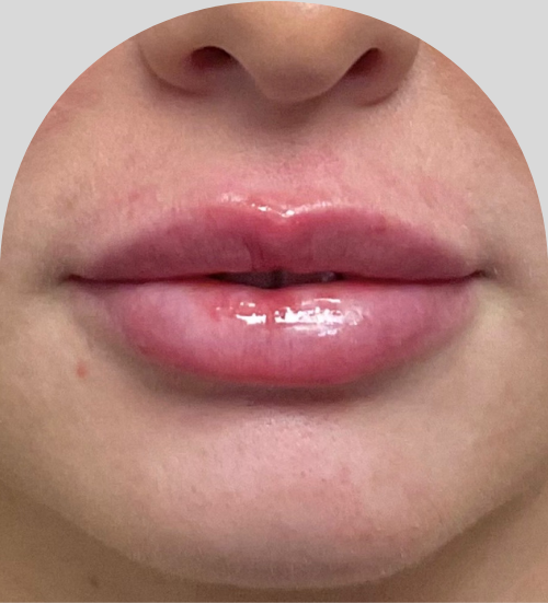 Lip Fillers - Case 53199 - After