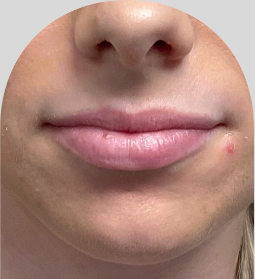 Lip Fillers - Case 53203 - Before