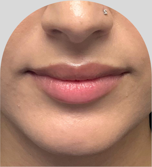Lip Fillers - Case 53207 - Before
