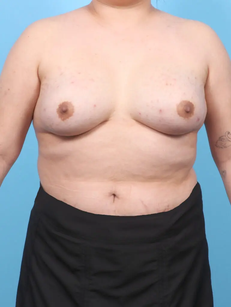 Breast Augmentation - Case 53229 - After