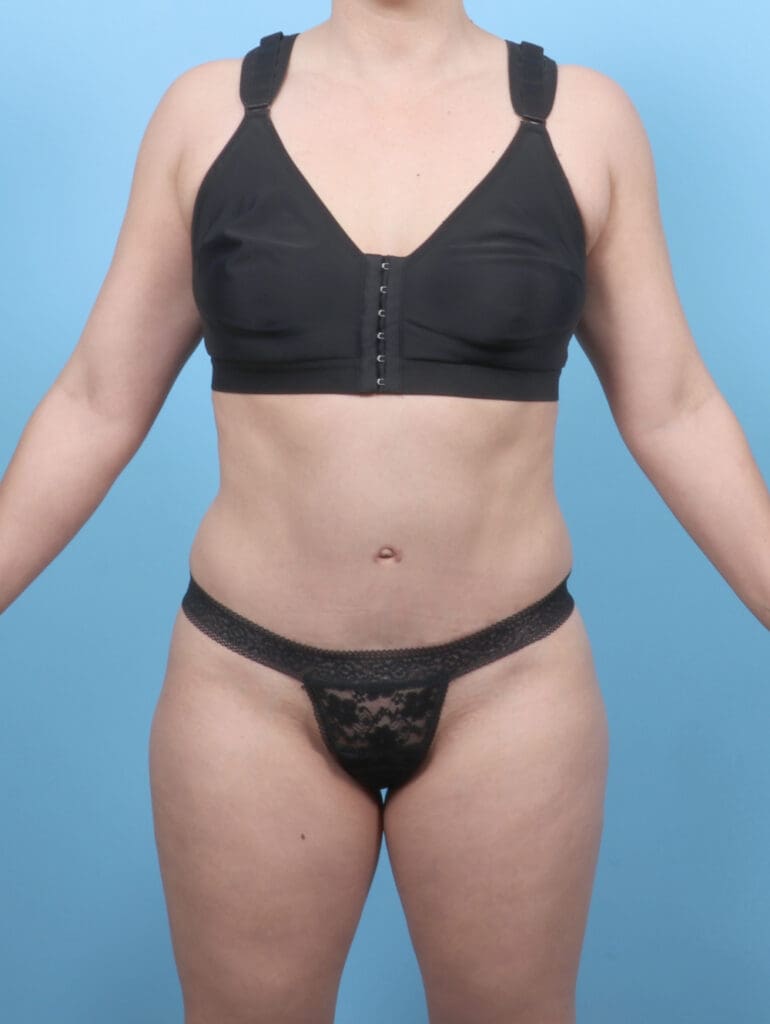 Tummy Tuck - Case 53385 - After
