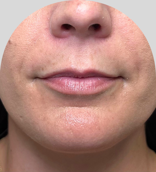 Lip Fillers - Case 53482 - Before
