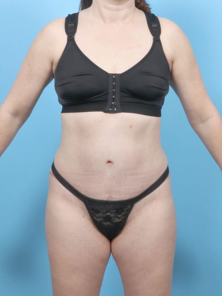Tummy Tuck - Case 53529 - After