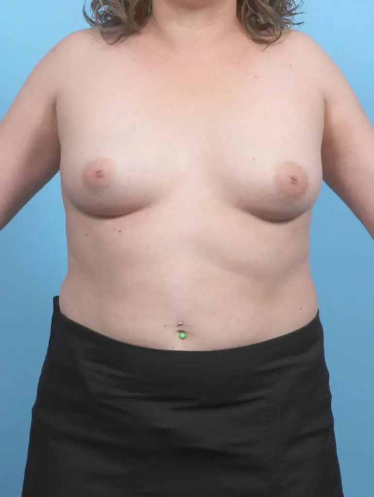 Breast Augmentation - Case 53537 - Before