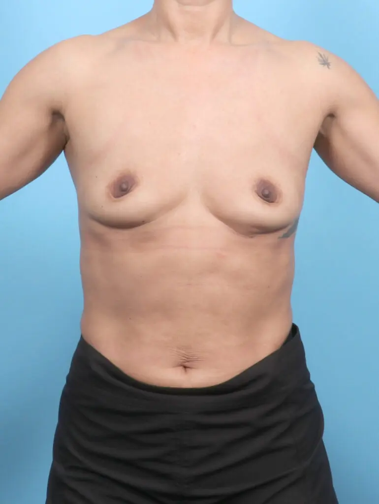 Breast Augmentation - Case 53579 - Before