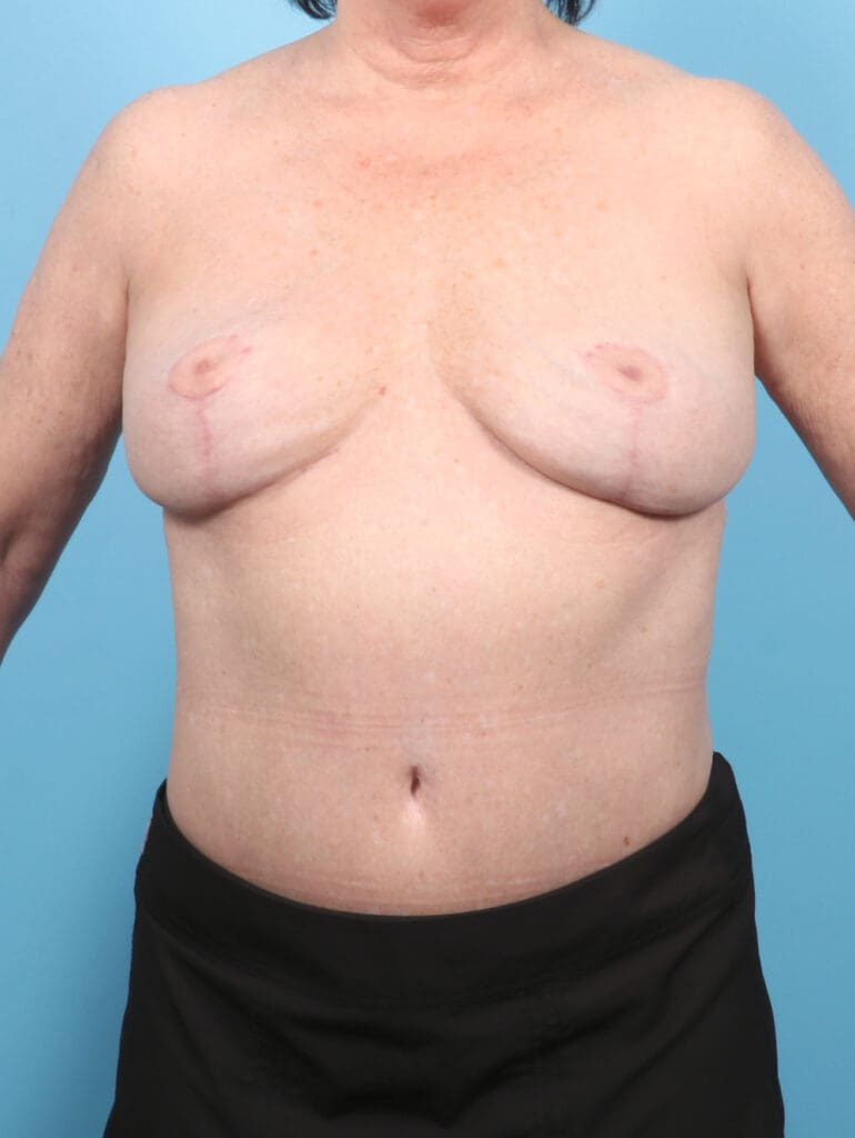 Breast Implant Removal - Case 53662 - After
