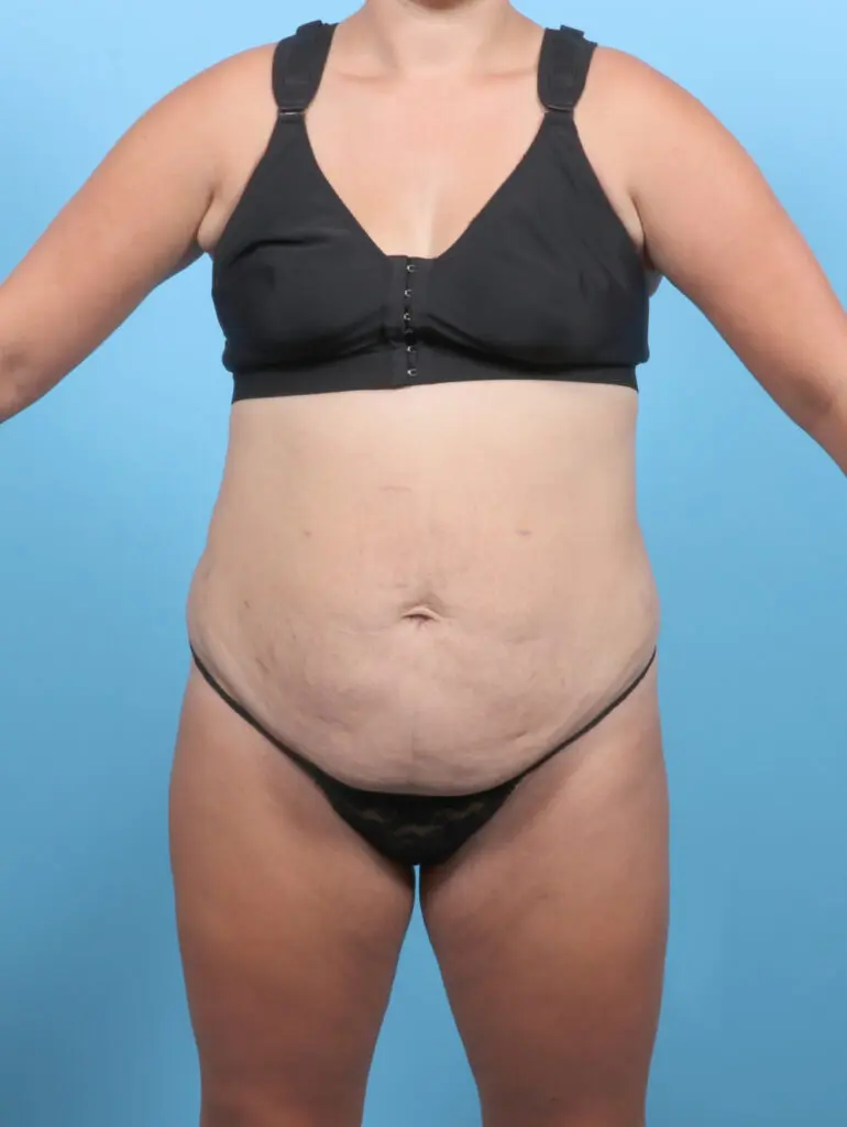 Tummy Tuck - Case 53784 - Before