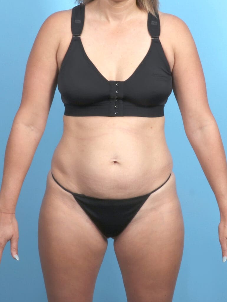 Tummy Tuck - Case 53888 - Before