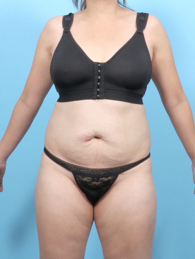 Tummy Tuck - Case 54139 - Before