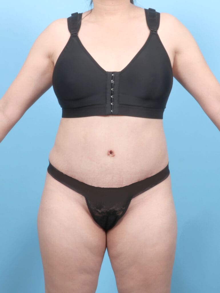 Tummy Tuck - Case 54139 - After