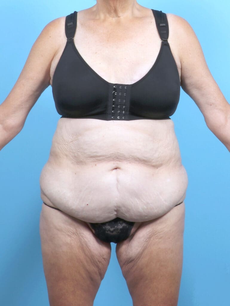 Tummy Tuck - Case 54267 - Before