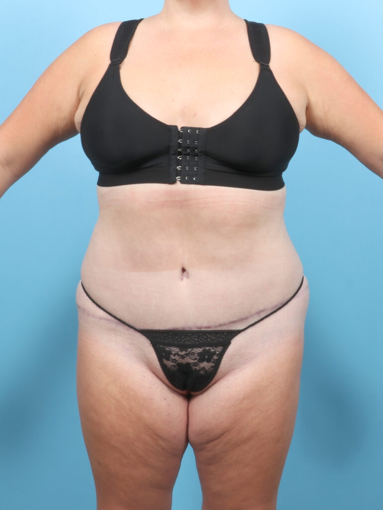 Tummy Tuck - Case 54993 - After