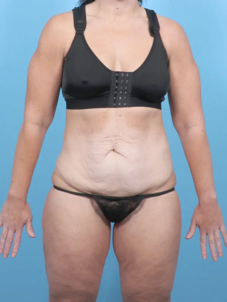 Tummy Tuck - Case 55057 - Before