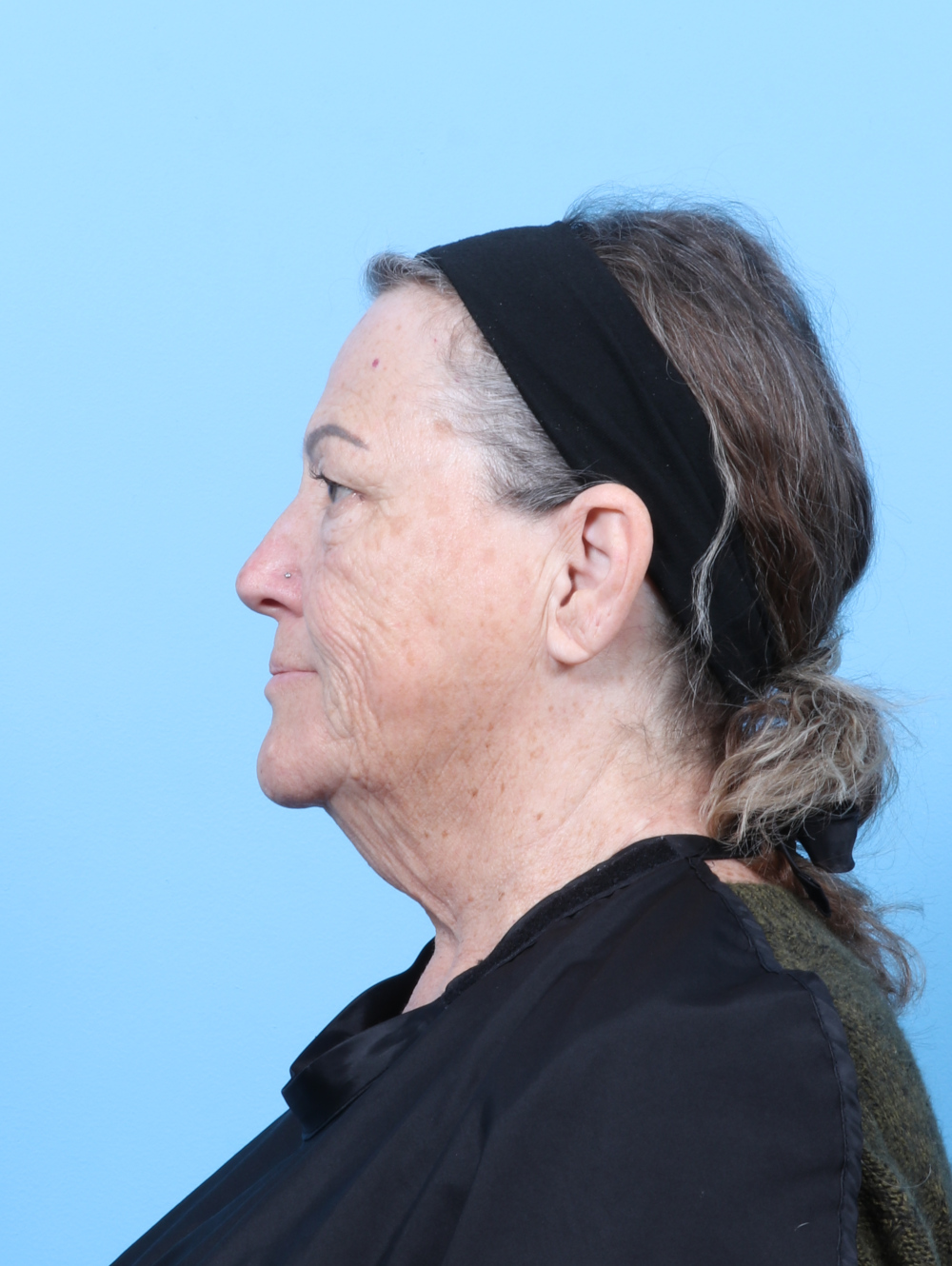 Eyelid Surgery Patient Photo - Case 59929 - before view-2