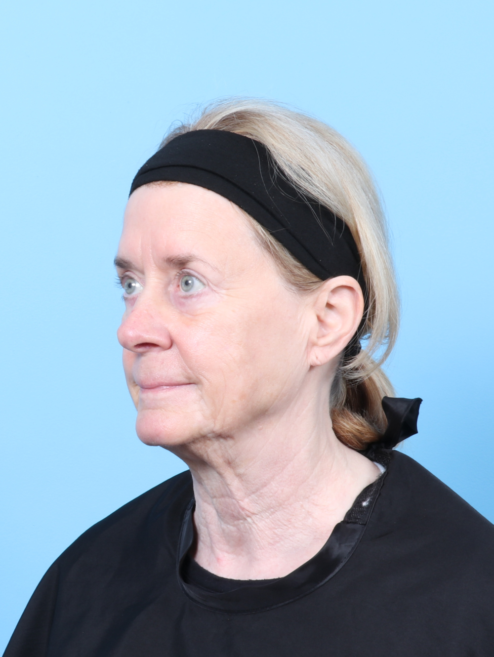 Bullhorn Lip Lift Patient Photo - Case 59984 - before view-1