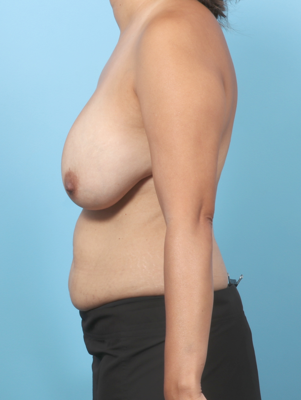 Breast Implant Revision Patient Photo - Case 61682 - before view-2
