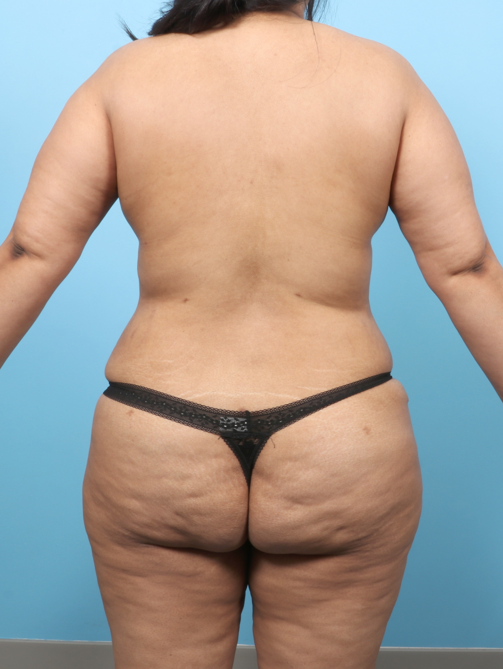 Tummy Tuck Patient Photo - Case 61909 - after view-3