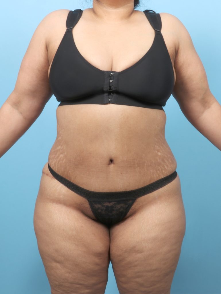 Tummy Tuck - Case 61909 - After