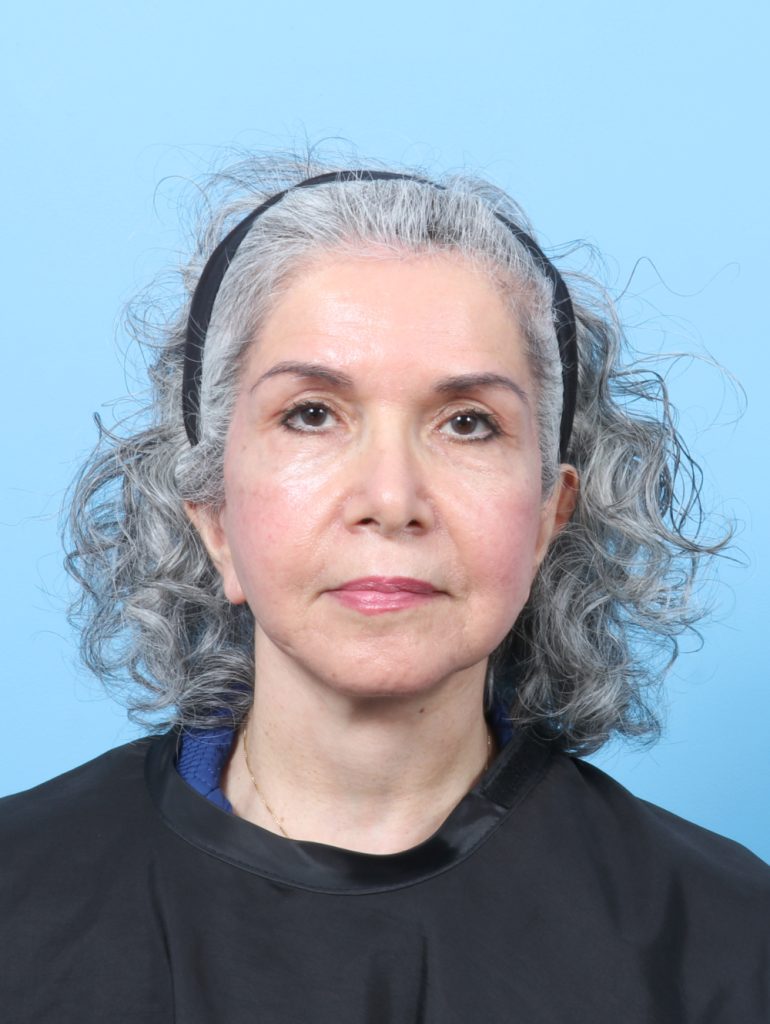 Facelift / Neck Lift - Case 61927 - After