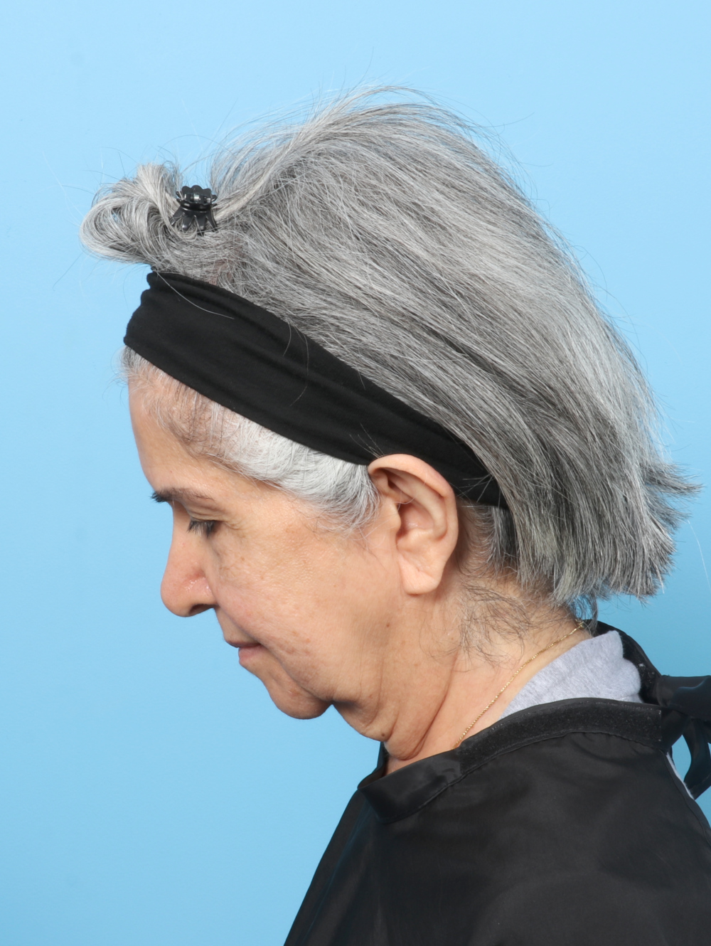 Facelift / Neck Lift Patient Photo - Case 61927 - before view-3