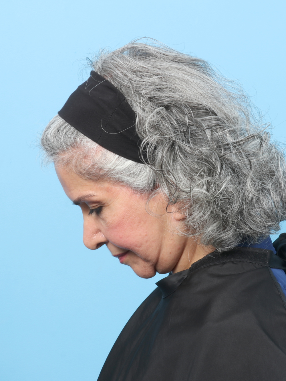 Facelift / Neck Lift Patient Photo - Case 61927 - after view-3