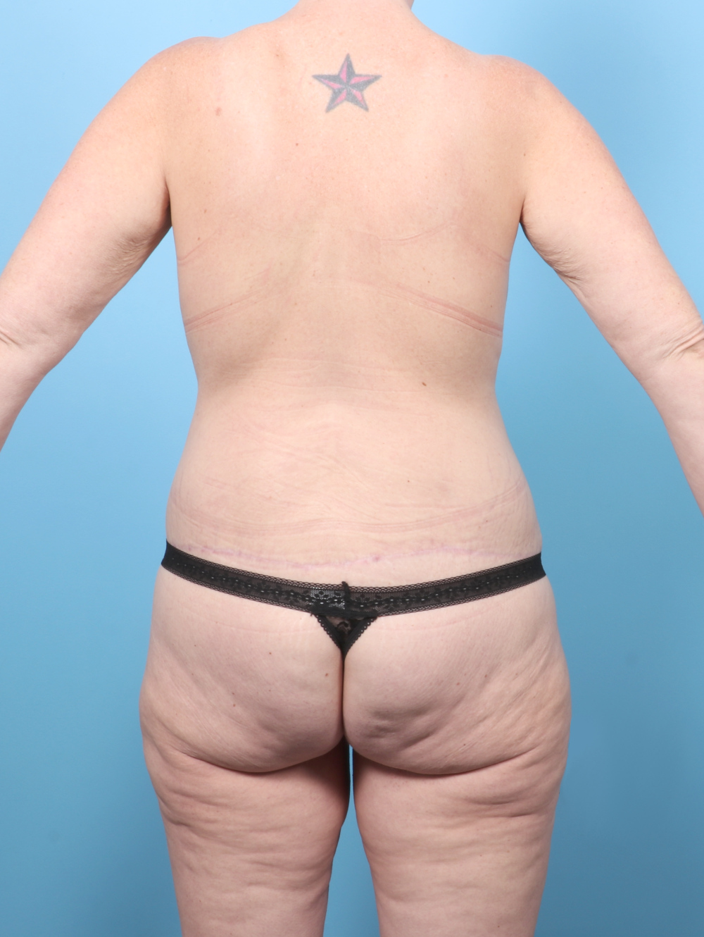 After Weight Loss Patient Photo - Case 61978 - after view-3