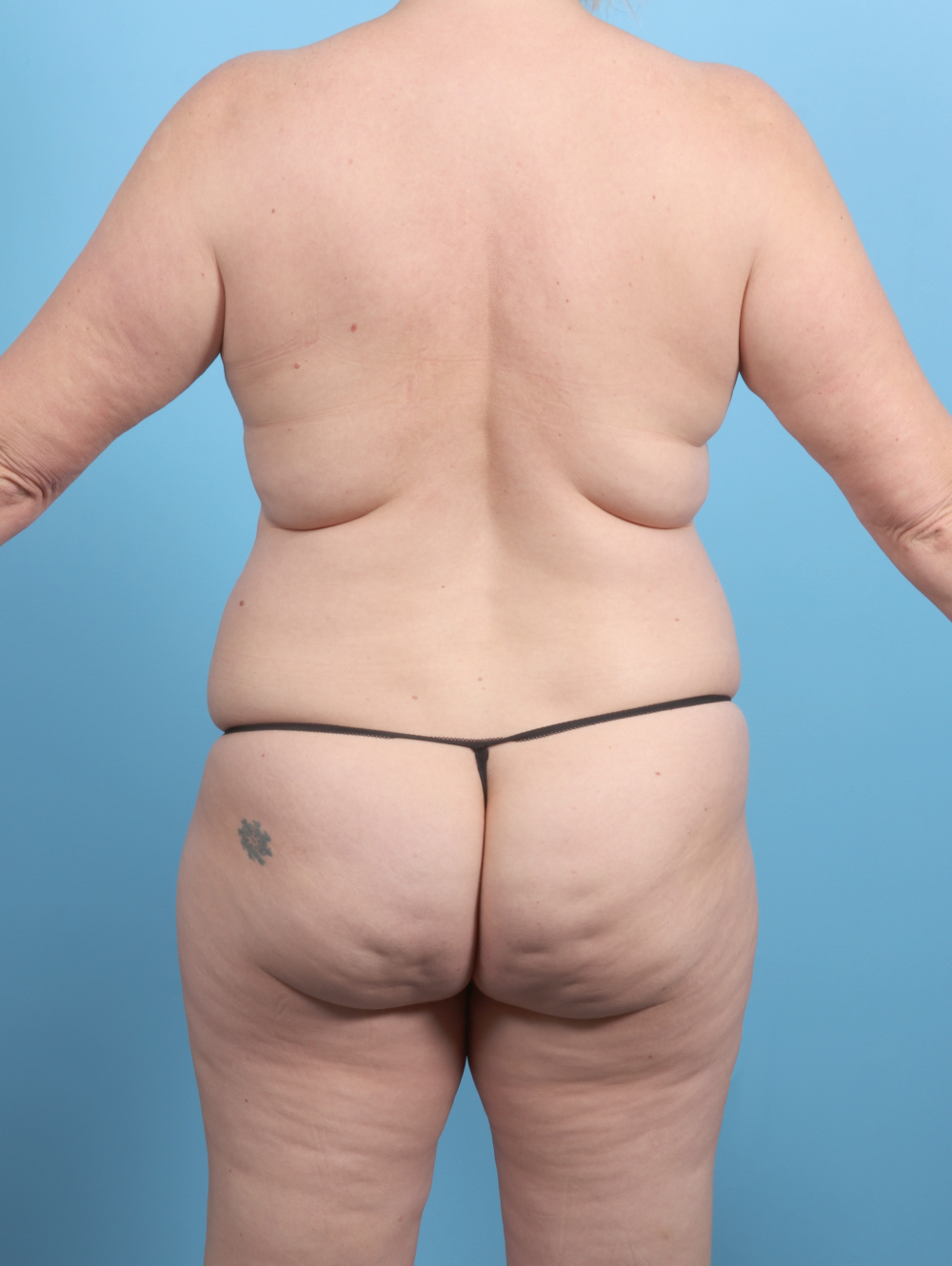 Breast Lift/Reduction w/o Implants Patient Photo - Case 62029 - before view-3