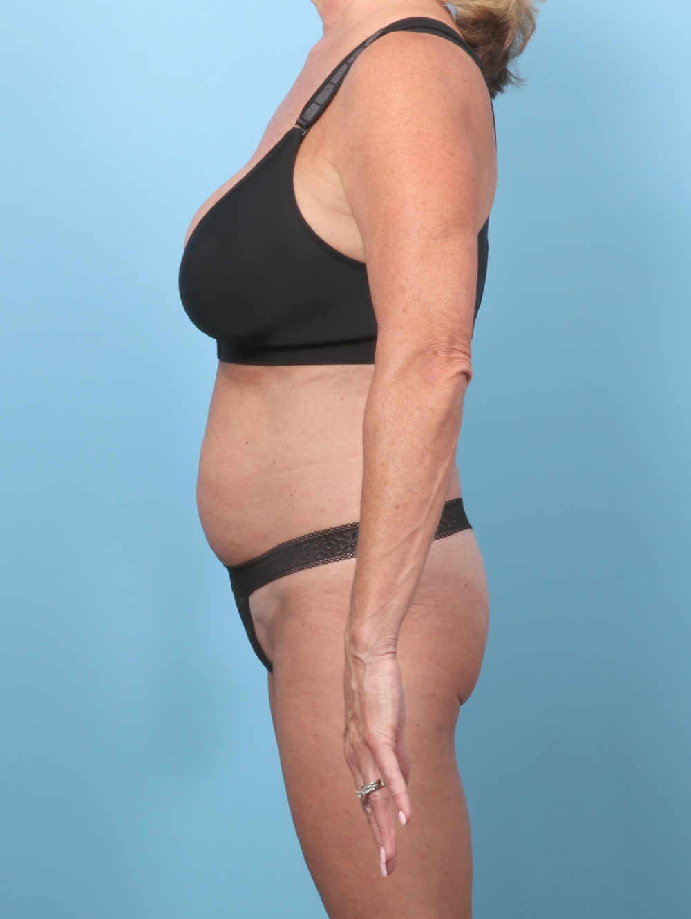 Tummy Tuck Patient Photo - Case 62089 - before view-2
