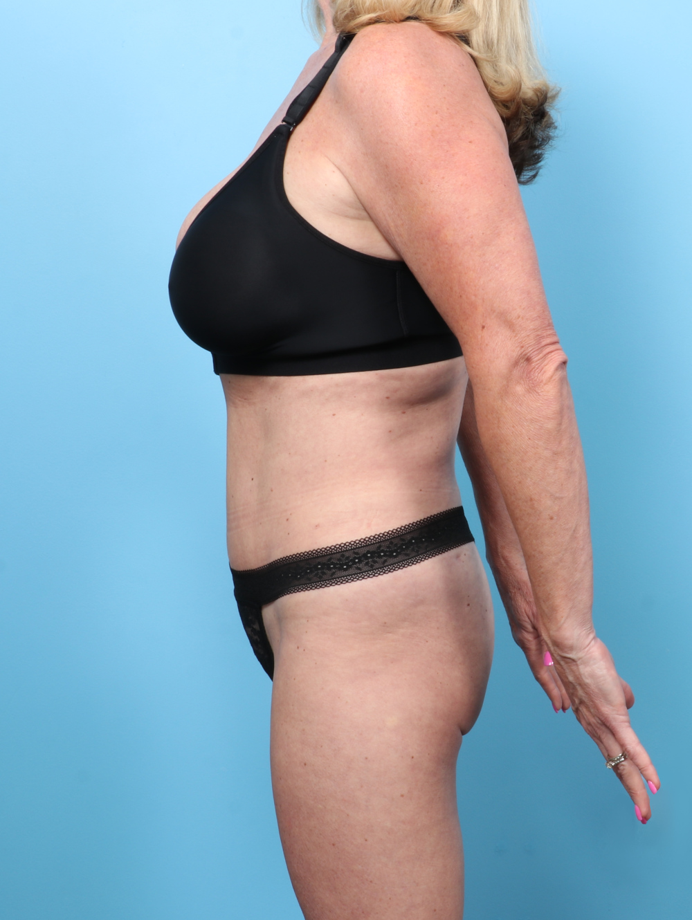 Tummy Tuck Patient Photo - Case 62089 - after view-2