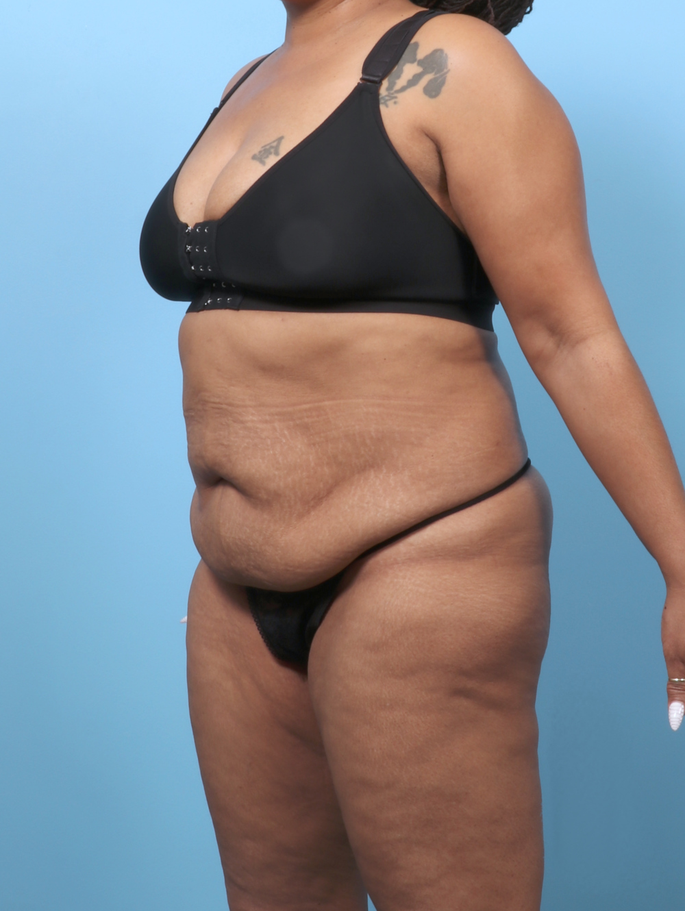 Tummy Tuck Patient Photo - Case 62099 - before view-1