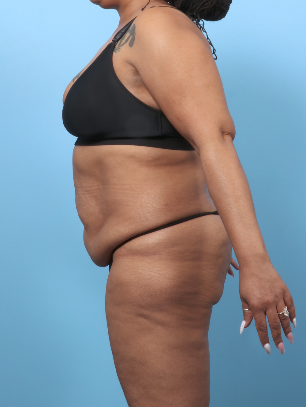 Tummy Tuck Patient Photo - Case 62099 - before view-2