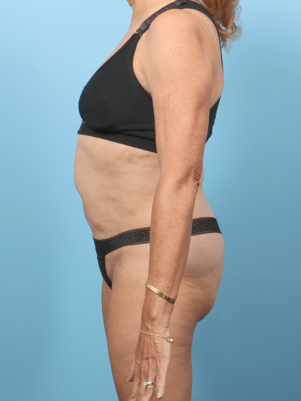 Tummy Tuck Patient Photo - Case 62226 - before view-2