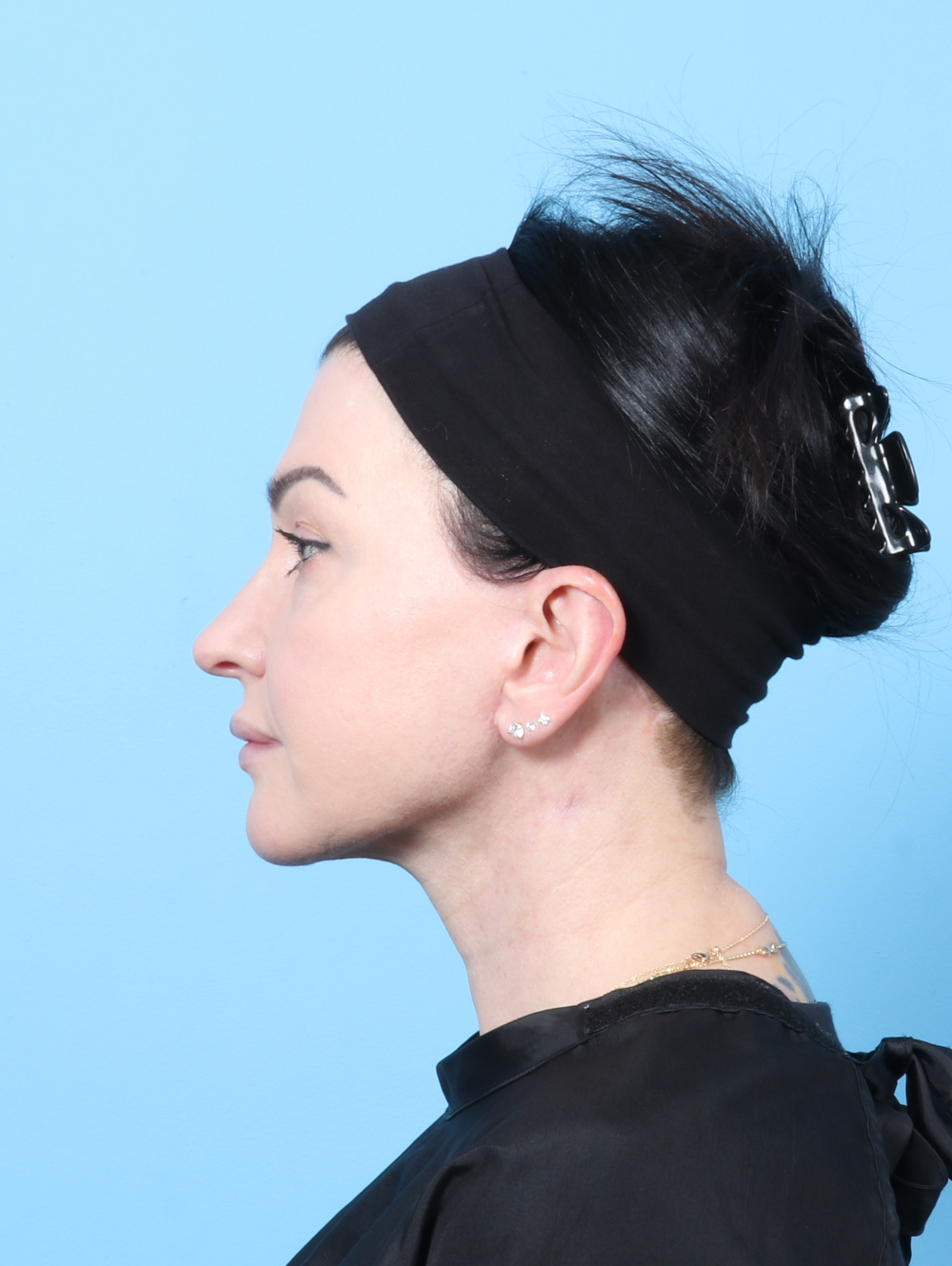 Facelift / Neck Lift Patient Photo - Case 62469 - after view-2