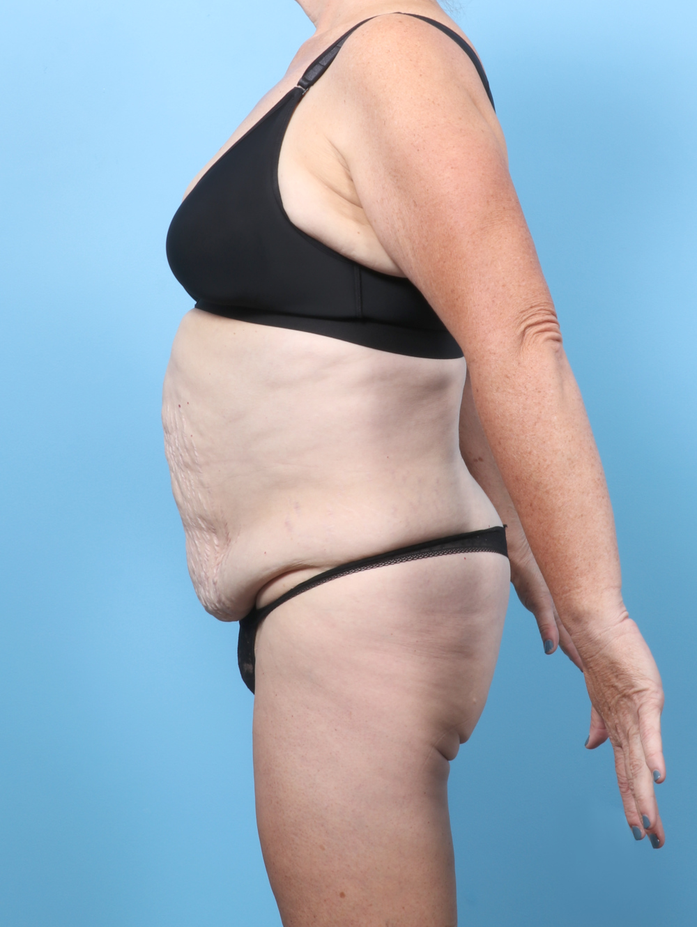 Tummy Tuck Patient Photo - Case 62479 - before view-2