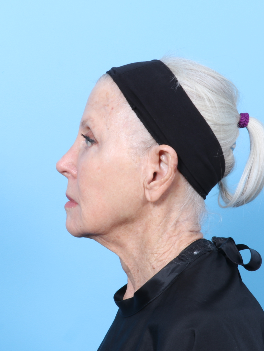 Facelift / Neck Lift Patient Photo - Case 62886 - before view-2