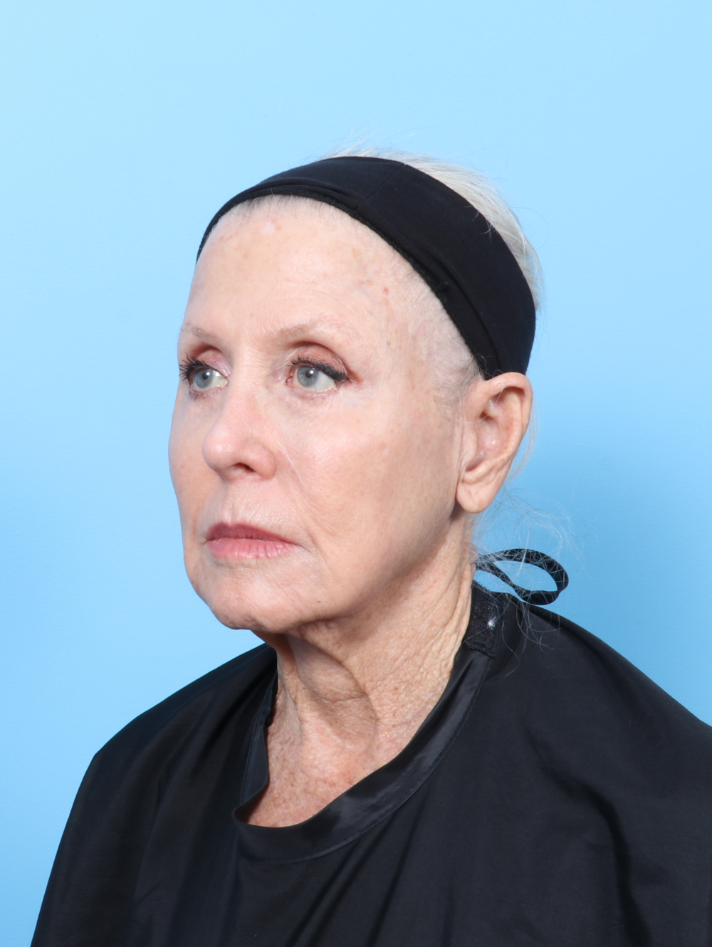 Facelift / Neck Lift Patient Photo - Case 62886 - before view-1