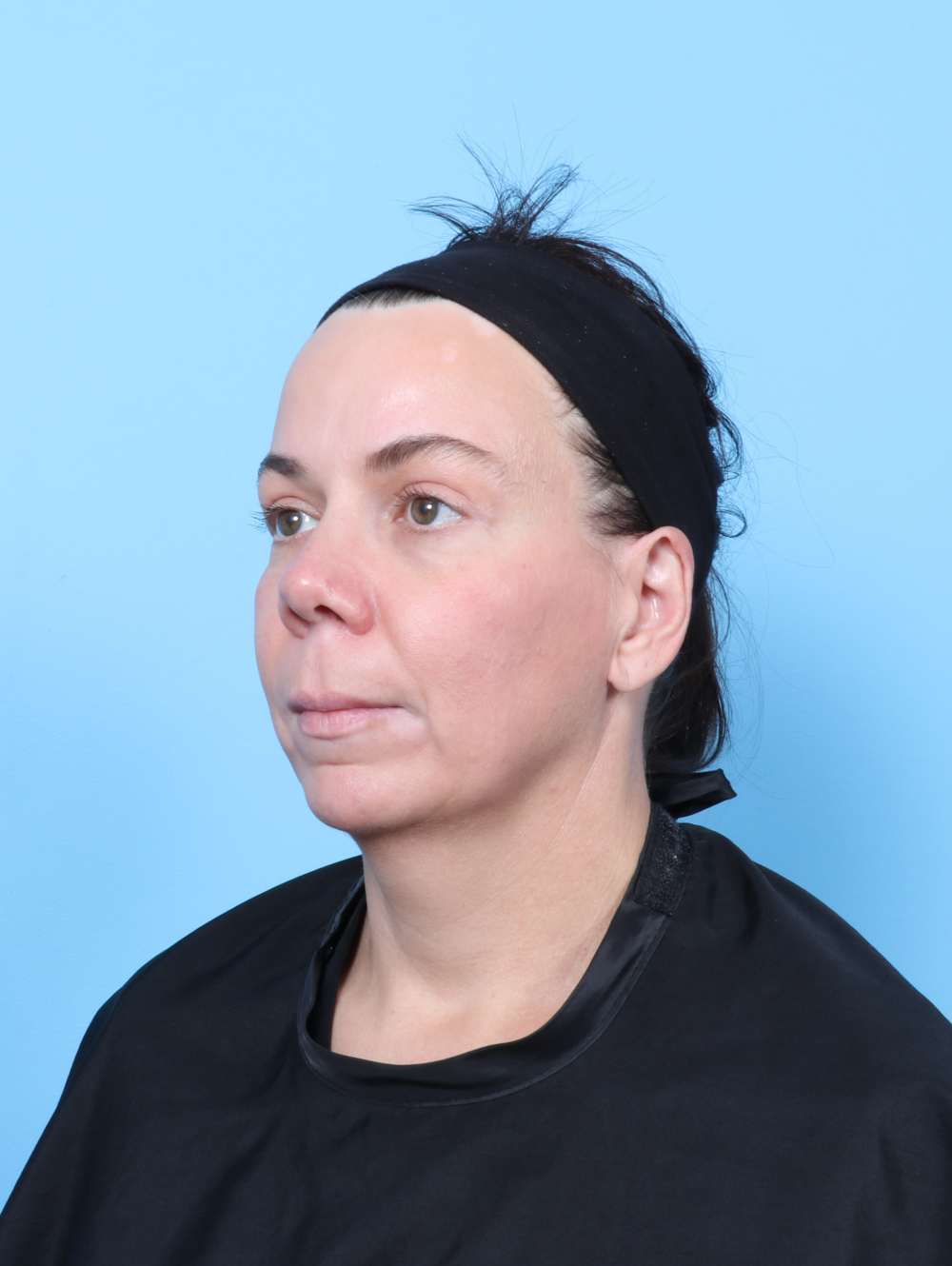 Eyelid Surgery Patient Photo - Case 62912 - after view-1