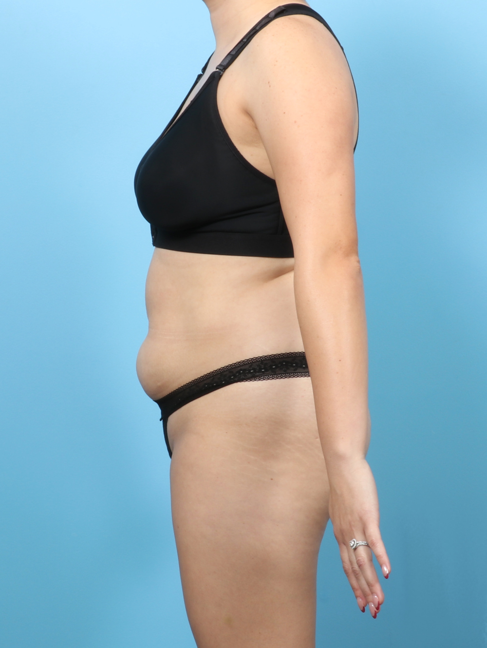 Liposuction Patient Photo - Case 63236 - before view-2