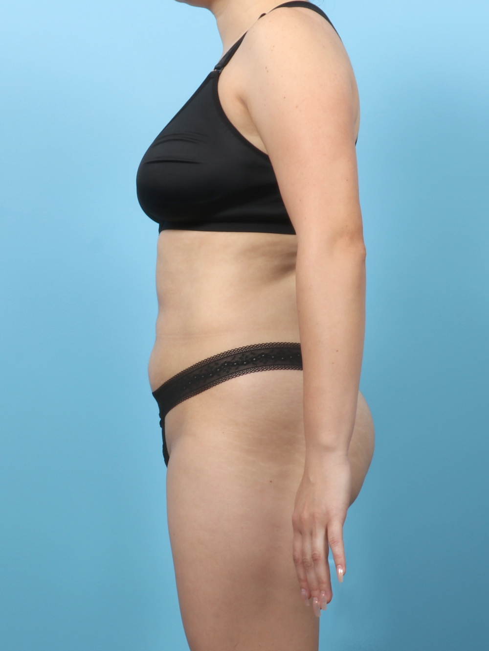 Liposuction Patient Photo - Case 63236 - after view-2