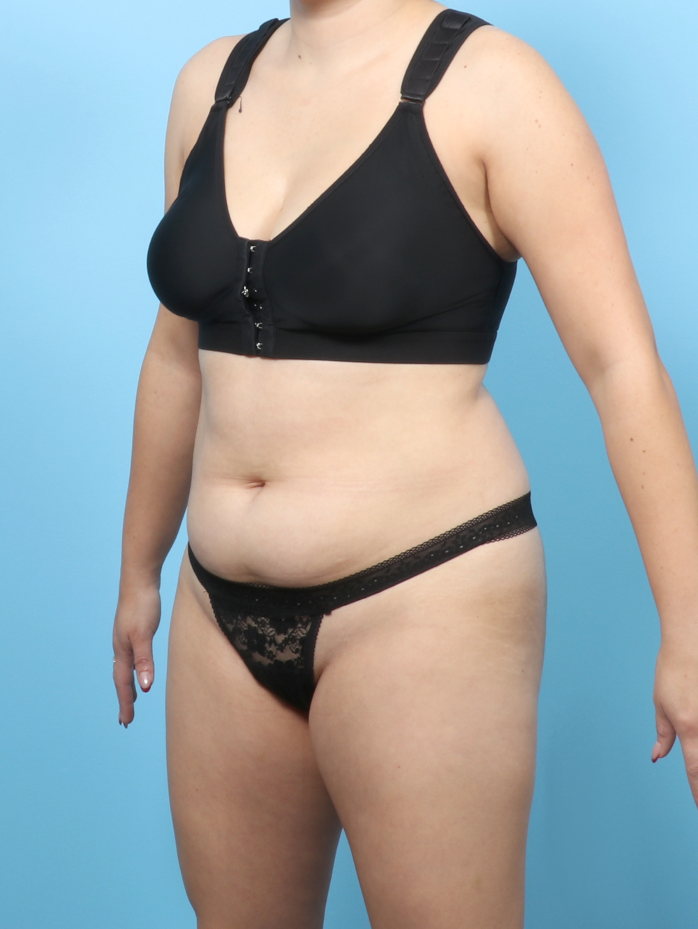 Liposuction Patient Photo - Case 63236 - before view-1
