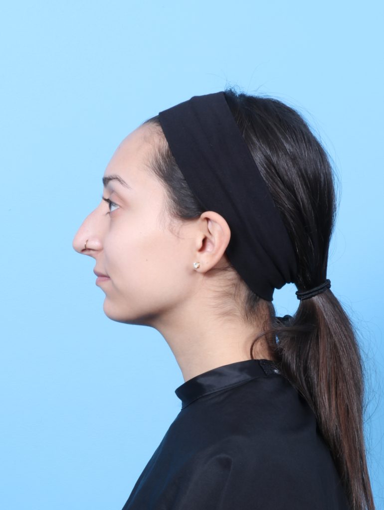 Rhinoplasty - Case 63309 - Before