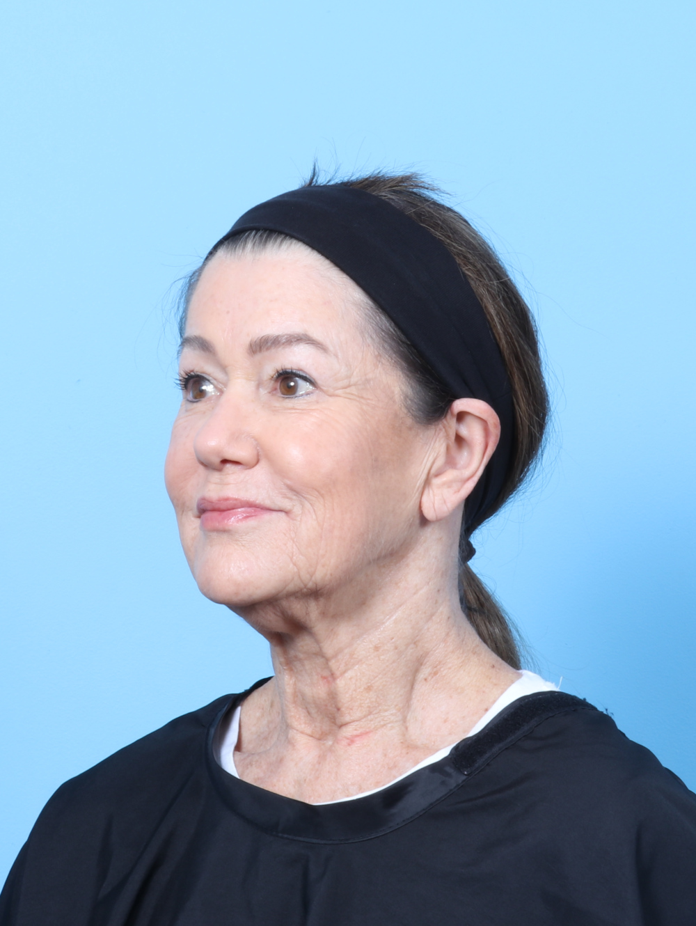 Facelift / Neck Lift Patient Photo - Case 63862 - before view-1