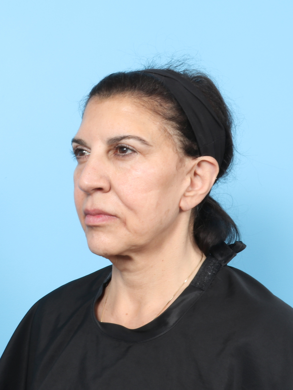 Brow Lift Patient Photo - Case 63875 - before view-1